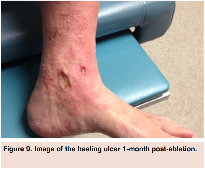 Venous Ulceration Secondary to Chronic Venous Insufficiency VDM